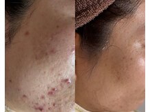 エヌ(N)/ハーブピーリングでの変化