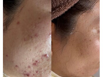 エヌ(N)/ハーブピーリングでの変化