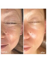 シャラ(shara)/大人気！新メニュー幹細胞上清液