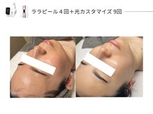 スパレーカ(Spa laka)/光カスタマイズ＋ララピール