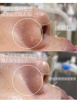 アイラッシュユーリ(Eyelash Juli)の写真/お顔のワックス脱毛でうぶ毛オフ！驚きのトーンアップ◎「ちゅるん」と輝く、加工いらずの素肌へ。