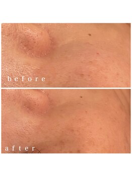 メナードフェイシャルサロン 岐阜茜部/毛穴ケア/くすみ