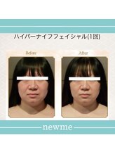 ニュウミー 諏訪本店(newme)/小顔　ビフォーアフター6
