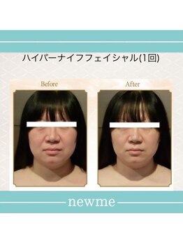 ニュウミー 諏訪本店(newme)/小顔　ビフォーアフター6