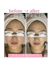 ポアレスサロン フィル(fil)/NEWルナ純国産光フェイシャル♪