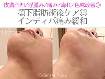 オリエンタルローザ 表参道(Oriental Rosa)/顎下脂肪後インディバ術後ケア◎