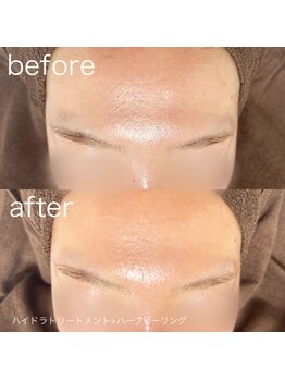 ルルラ リコ(lulula rico)/症例写真/ハーブピーリング