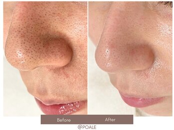 ポアレ 高崎店(POALE)/毛穴ケア症例【群馬/高崎】