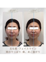 りもあず(ReMore-S)/むくみが気になる/首コリ/頭痛