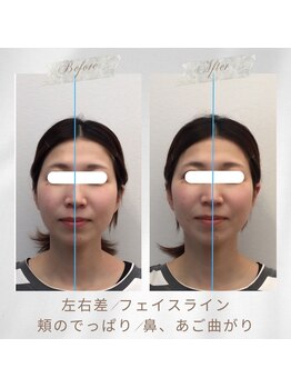 りもあず(ReMore-S)/むくみが気になる/首コリ/頭痛