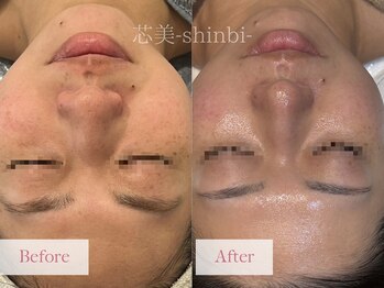 芯美 恵比寿店(shinbi)/クリスティーナ施術3回