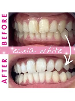 エクシアホワイト 新宿御苑店(ecxia white)/ホワイトニングビフォーアフター