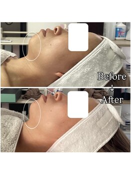 ポラス(Polus)/REDショット/フェイシャル