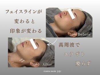 ジュジュ(juju)/異物を入れ続けますか?