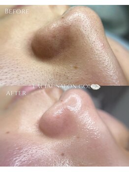 ゴールド 栄店(GOLD)/毛穴改善コース ５回後