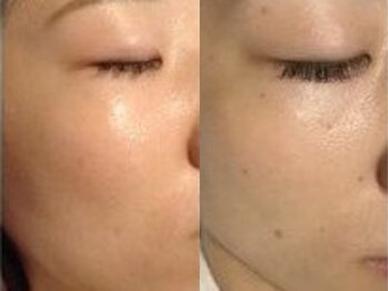 アイリープ(eyeleap)/☆シミケア集中!小顔筋膜リフト