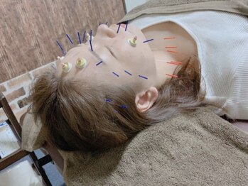 アパト鍼灸院(APaT)/鍼灸+パーソナルトレーニング