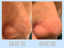 リブ(LIB)/毛穴洗浄ウォーターピーリング14