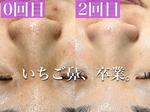 シルキー 新宿店(SILKY)の雰囲気（新宿/剥けないハーブピーリング/クリスティーナハーブピーリング）