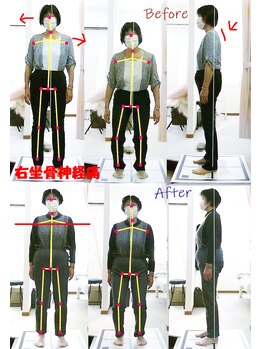 姫路なごみ整体院 なごみ鍼灸院/(改善例)　右坐骨の痛み