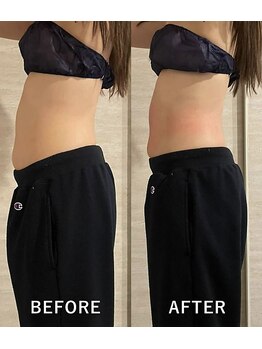 オーロラ(Aurora)/痩身ダイエットコースの1回目