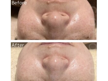 ココロ(COCORO)/プラピール2回施術