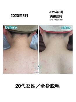 サロンアメリ 高松丸亀町店(Salon Ameri)/香川 高松 うなじ脱毛 アメリ