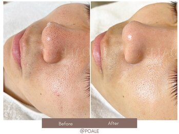 ポアレ 高崎店(POALE)/毛穴ケア症例【群馬/高崎】