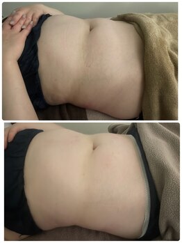 サルサナ(Salu Sana)/脂肪分解セラム導入