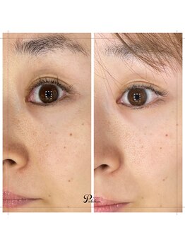 プルクレ 常磐町店(Pulchre)/ホームケア1週間の結果♪