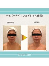ニュウミー 諏訪本店(newme)/小顔　ビフォーアフター7