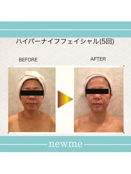 ニュウミー 諏訪本店(newme)/小顔　ビフォーアフター7
