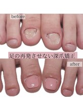 ティアラネイル 宇都宮/再発させない深爪矯正