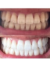 ハク 南船橋店(HAKU)/☆ホワイトニング☆事例写真１