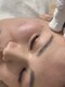 じぶんniプラスの写真/【50歳からの肌質改善プログラム】最高級のプラズマケアでシミにアプローチ。お肌を育てて土台からキレイに