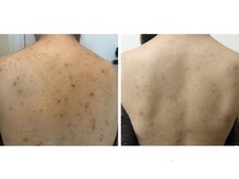 エステサロン ピリナ(pilina)の雰囲気（背中ハーブピーリングで最短3ヶ月で結果出し◎リンパ付きも人気!）