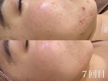 ホワイトアクア 天王寺本店(WHITE AQUA)/ハーブピーリング/毛穴/天王寺