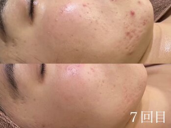 ホワイトアクア 天王寺本店(WHITE AQUA)/ハーブピーリング/毛穴/天王寺