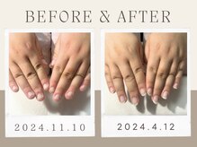 ピノ(pino)の雰囲気(5ヶ月でこの変化!長年の深爪のお悩みは当店にお任せ下さい!)