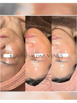 ヴィーナス(Venus)/白玉スキンフェイシャル