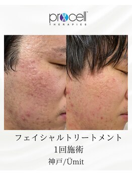 ユミト(Umit)/プロセルスカルプ