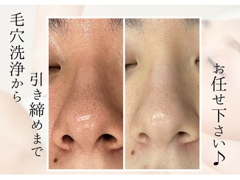 リヴェーヌ 呉羽店(Riverne)の写真/[黒ずみ/毛穴の詰まり/開き]セルフケアでは届かない毛穴汚れもマシンでごっそり☆プロにお任せ！