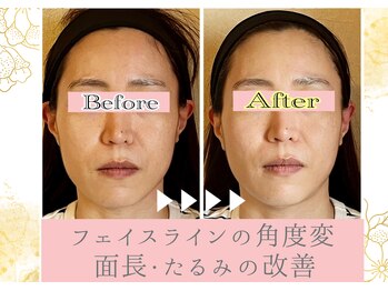 ラトビア(Latvia)/頭蓋骨小顔矯正×ヘッドスパ