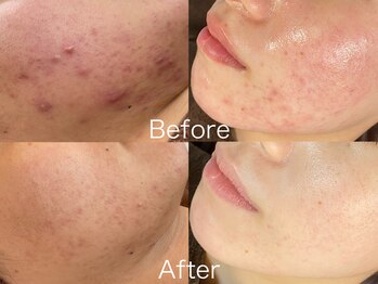 ビスキン(BeSkin)