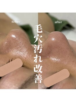 リモナ(Re-mona..)/REVIハーブピーリング×毛穴洗浄