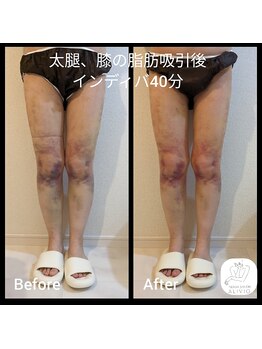 アリビオ(ALIVIO)/ツラい浮腫、内出血に!!