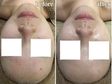 アンジュ(Ange)/陶器トリートメント