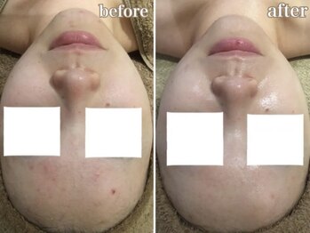 アンジュ(Ange)/陶器トリートメント