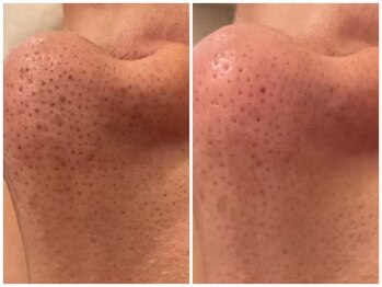 メゾンリュバン 梅田店(Maison Ruban)/毛穴洗浄・美白フォト|毛穴ケア