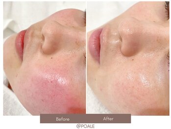 ポアレ 高崎店(POALE)/毛穴ケア症例【群馬/高崎】